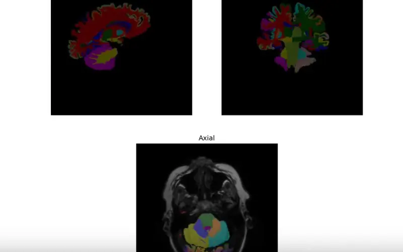 Brain MRI Segmentation: sagittal, coronal and axial views segmented from the same volume